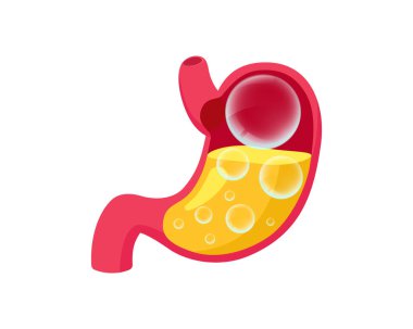 Şişmiş mide ve içinde gazlar olan şeffaf toplar. Sindirim sistemi şişkinliği sorunu. Aşırı hazımsızlık ve mide hastalığı. Karın ağrısı, tıbbi vektör çizimi.