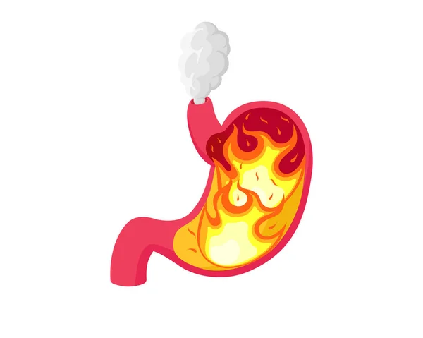 胃の中に酸を燃焼して胸焼け。消化器系胃炎の問題.消化不良と腹病.火事による胃の痛み。胃食道逆流ベクトル図 — ストックベクタ