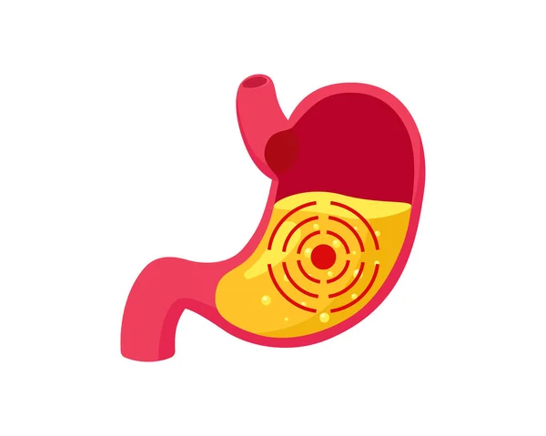 Ulcera allo stomaco con succo gastrico all'interno e bersaglio. Problemi di gastrite dell'apparato digerente. Indigestione e malattia della pancia. Dolore addominale gastrico. Illustrazione vettoriale medica — Vettoriale Stock