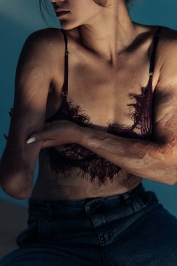 Beautiful young woman with amputee arm and scars from burn on her body poses in lacy bra. The concept of a fulfilling life of persons with disabilities.