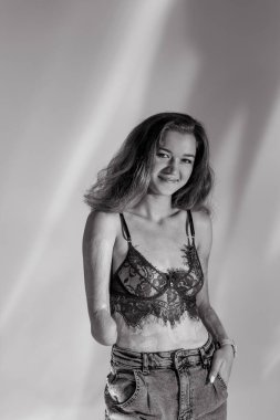 Smiling young woman with amputee arm and scars from burn on her body poses in lacy bra. The concept of a fulfilling life of persons with disabilities. Black and white image.