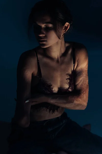 Beautiful young woman with amputee arm and scars from burn on her body poses in lacy bra. The concept of a fulfilling life of persons with disabilities.