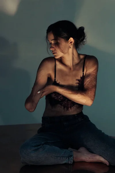 Beautiful young woman with amputee arm and scars from burn on her body poses in lacy bra. The concept of a fulfilling life of persons with disabilities.