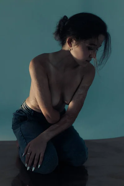 Beautiful young woman with amputee arm and scars from burn on her body poses topless. The concept of a fulfilling life of persons with disabilities.