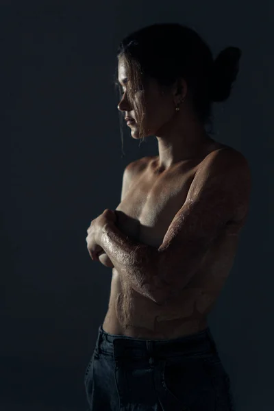 Beautiful young woman with amputee arm and scars from burn on her body poses topless. The concept of a fulfilling life of persons with disabilities.