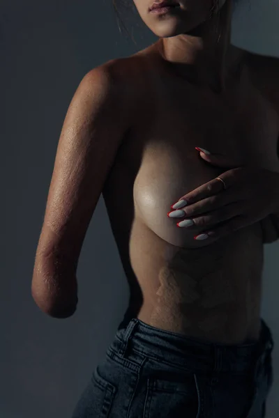 Beautiful young woman with amputee arm and scars from burn on her body poses topless. The concept of a fulfilling life of persons with disabilities. Closeup.