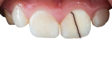 Şımarık, çürük diş çizimi. İzole edilmiş arkaplan