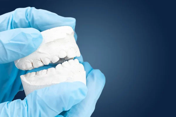 Mano de ortodoncistas, cubierta con un guante médico azul que sostiene un molde dental de la mandíbula inferior. Los dientes parecen un poco torcidos.. — Foto de Stock