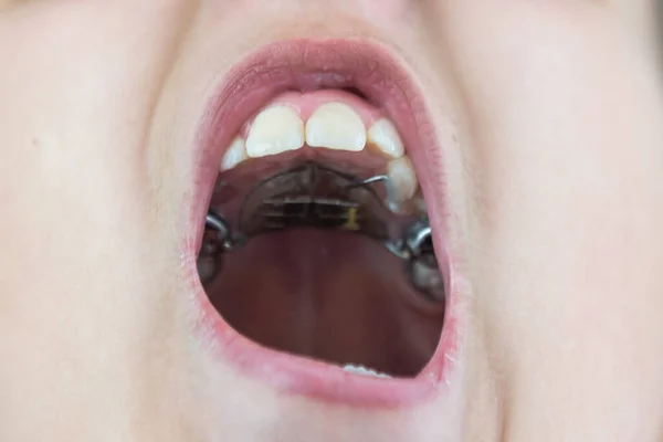 Vista cortada da menina a mandar verificar a matrícula. Retrato de close-up de menina adolescente sorridente com placas de dentes contra dentista sentado na clínica. Menina com placas sendo examinadas pelo dentista — Fotografia de Stock