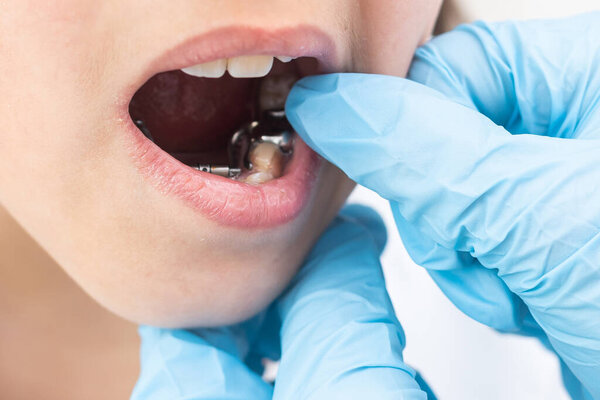 Girl putting on medical braces for orthodontic treatment over white.