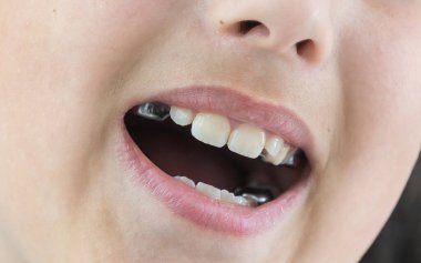 Dişlerinde plaka olan küçük bir kız.