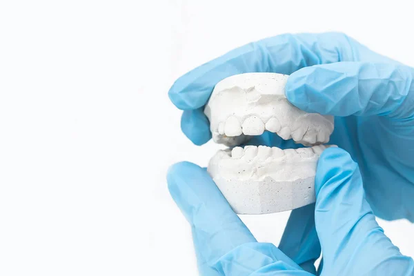 Mano de ortodoncistas, cubierta con un guante médico azul que sostiene un molde dental de la mandíbula inferior. Los dientes parecen un poco torcidos.. — Foto de Stock