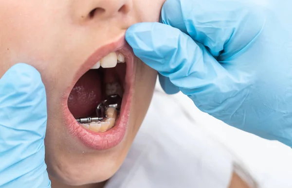 Portret dziewczynki pokazuje jej urządzenie ortodontyczne na białym tle — Zdjęcie stockowe