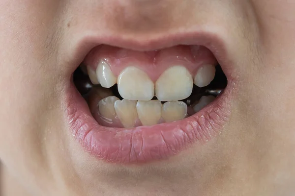 Dospělí trvalé zuby přicházející před dítě dětské dětské zuby: žraločí zuby. Holčičky otevírají pusu. konzultace se zubařem. problém. — Stock fotografie