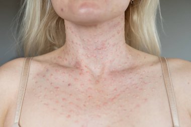 Yüzüne güzellik iğnesi yaptıktan sonra papüller. Yakın plan fotoğraf.