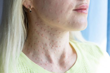 Beyaz arka planda gerçek cilt Biorevalizasyonu. Kadın yüzünde biyo-evrimsel enjeksiyon izleri var. Biyolojik evyalizasyon iğnesi, Hyaluronik enjeksiyondan sonra gerçek papüllerin güzellik tedavisinde kullanıldığını gösteriyor..