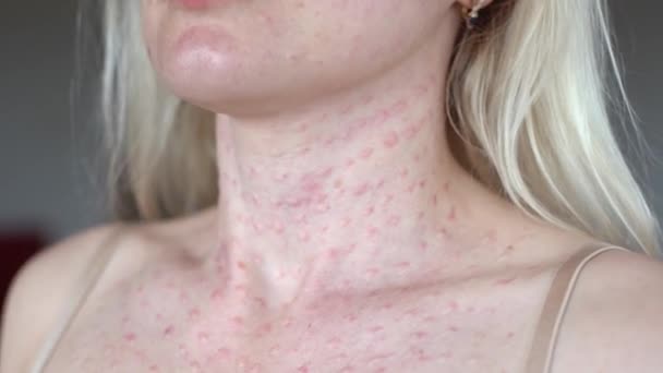 Papules after beauty injections on the face. Closeup photo — Video