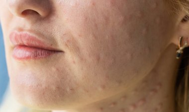 Beyaz arka planda derinin gerçek biyo-evrimleşmesi. Bir kadının yüzünde biyo-evrim enjeksiyonu izleri var. Biorevyalizasyon iğnesi izleri