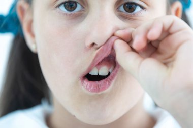 Adult permanent teeth coming in front of the child baby teeth: shark teeth. Little girls open mouth. consultation of dentist. problem