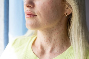 Beyaz arka planda gerçek cilt Biorevalizasyonu. Kadın yüzünde biyo-evrimsel enjeksiyon izleri var. Biyolojik evyalizasyon iğnesi, Hyaluronik enjeksiyondan sonra gerçek papüllerin güzellik tedavisinde kullanıldığını gösteriyor.