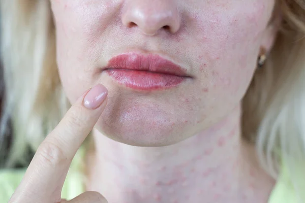 Verklig Hud Biorevitalisering Vit Bakgrund Spår Biovitalisering Injektioner Kvinnans Ansikte — Stockfoto