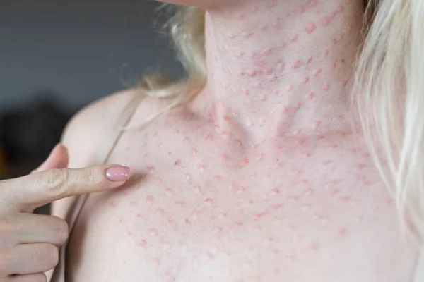 Verklig Hud Biorevitalisering Vit Bakgrund Spår Biovitalisering Injektioner Kvinnans Ansikte — Stockfoto