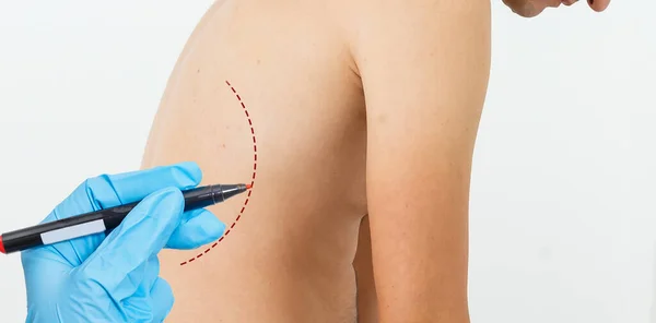 Doctor Tekening Merken Mannen Lichaam Voor Cosmetische Chirurgie Operatie Tegen — Stockfoto