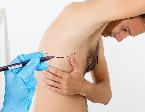 Läkare Ritar Märken Mans Kropp För Kosmetisk Operation Mot Vit — Stockfoto
