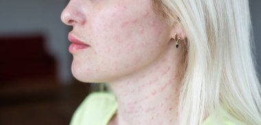 Beyaz arka planda derinin gerçek biyo-evrimleşmesi. Bir kadının yüzünde biyo-evrim enjeksiyonu izleri var. Biorevyalizasyon iğnesi izleri