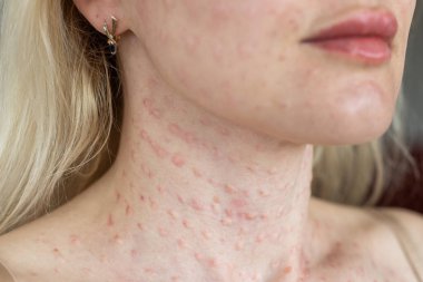 Beyaz arka planda gerçek cilt Biorevalizasyonu. Kadın yüzünde biyo-evrimsel enjeksiyon izleri var. Biyolojik evyalizasyon iğnesi, Hyaluronik enjeksiyondan sonra gerçek papüllerin güzellik tedavisinde kullanıldığını gösteriyor.