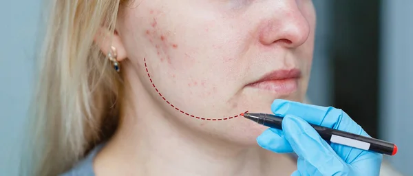 Médico Cirugía Plástica Traza Línea Barbilla Del Paciente Concepto Cirugía —  Fotos de Stock