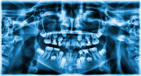 different types of wisdom teeth problems concept. Problem teeth X-ray image scanned.