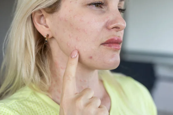 Papules Beauty Injections Face Closeup Photo — Stockfoto