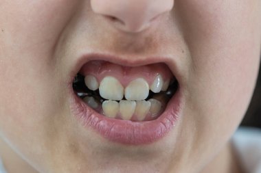 Dişleri değişmiş küçük bir kız dişlerini gösteriyor.