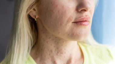 Yüzüne güzellik iğnesi yaptıktan sonra papüller. Yakın plan fotoğraf..