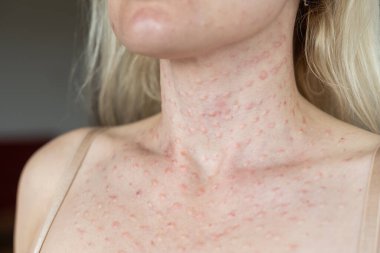 Beyaz arka planda derinin gerçek biyo-evrimleşmesi. Bir kadının yüzünde biyo-evrim enjeksiyonu izleri var. Biorevyalizasyon iğnesi izleri