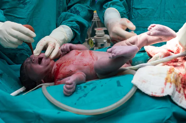 Cesarean section — Stock Photo, Image