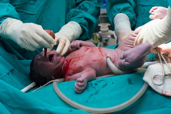 Cesarean afdeling — Stockfoto