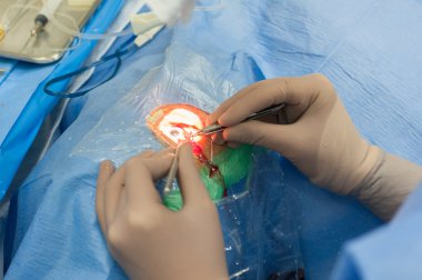 Katarakt sugery