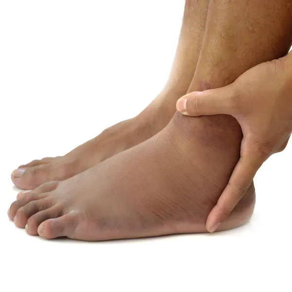 Ankle sprain — Stock Photo, Image