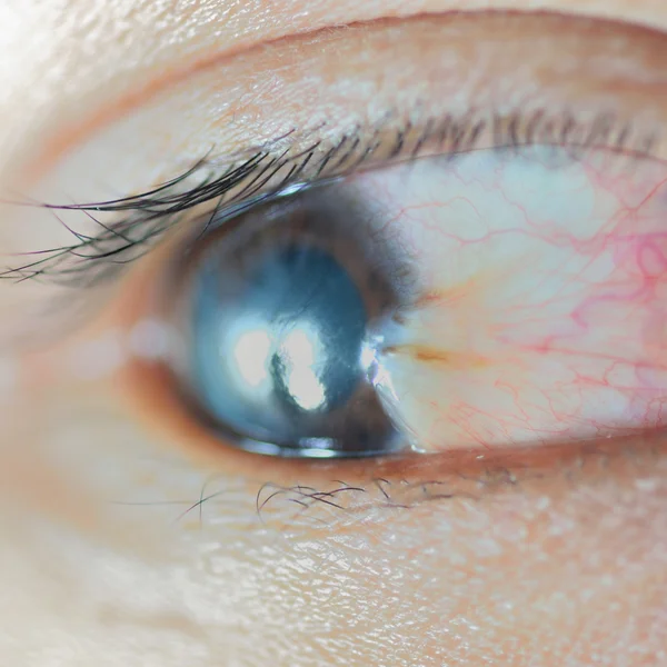 Pterygium (bindvliezen) — Stockfoto