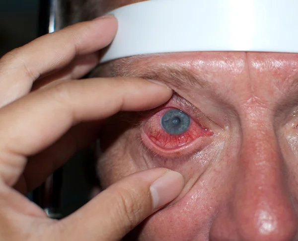 1 Corneal Ulcer Stock Photos Images Download Corneal Ulcer Pictures On Depositphotos 1 Corneal Ulcer Stock Photos Images Download Corneal Ulcer Pictures On Depositphotos