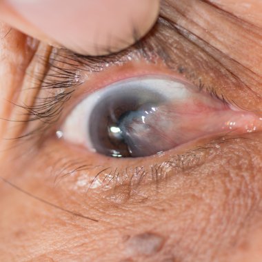 pterjium