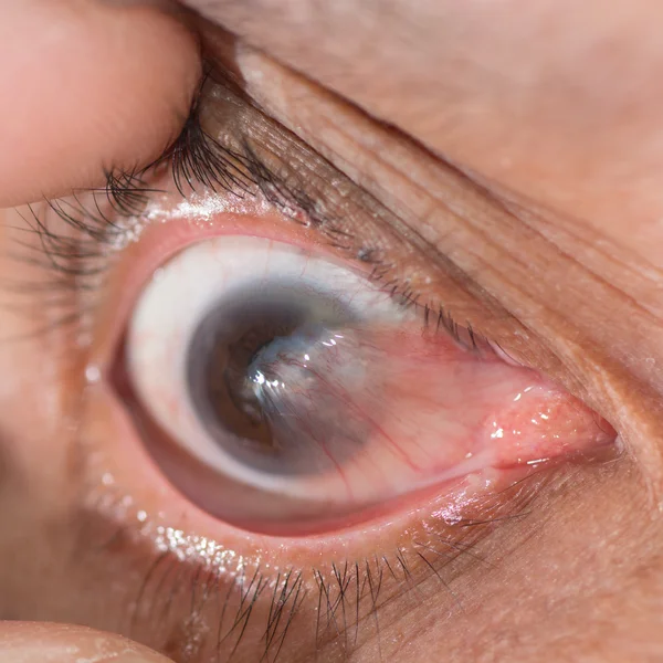 Pterygium — Φωτογραφία Αρχείου