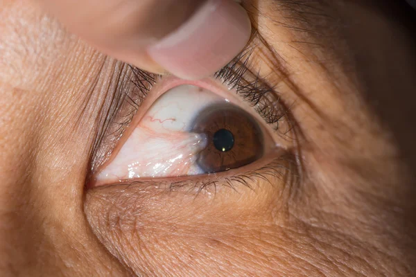 Pterygium — Stock Photo, Image