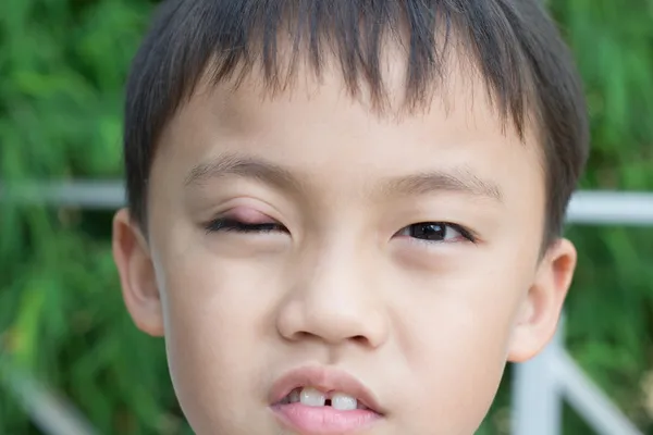 膿瘍"麦粒腫を持つ少年" — ストック写真