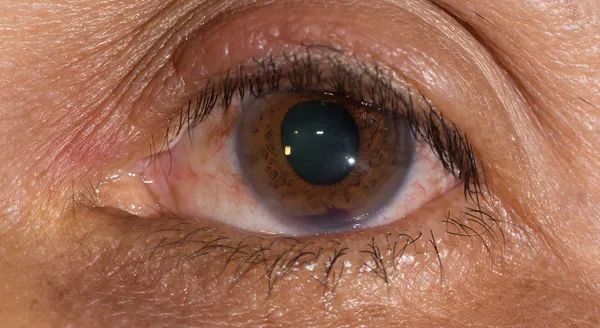 Hyphema oog — Stockfoto