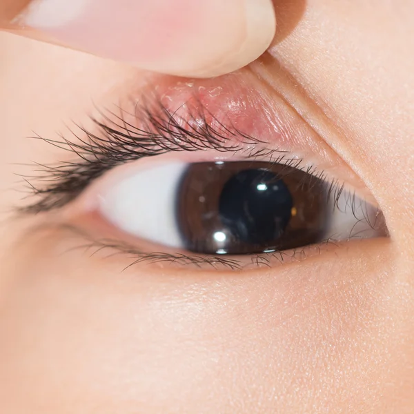 Oog deksel abces "stye" — Stockfoto