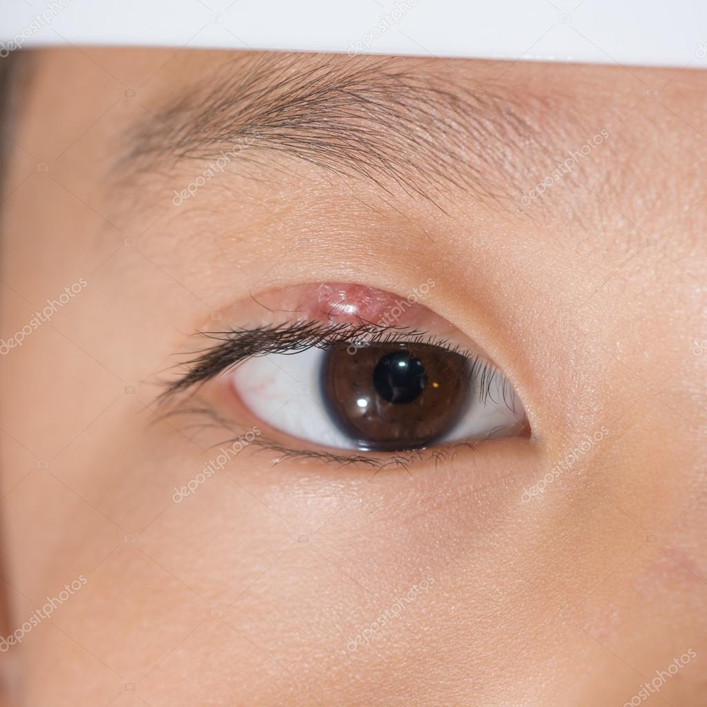 Eye lid abscess "stye" — Stock Photo © arztsamui 47536457
