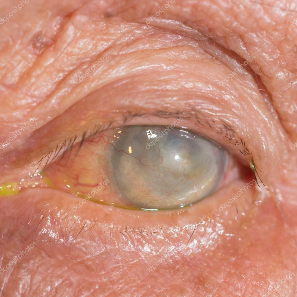 Agyi implantátummal, a szem megkerülésével állították vissza részlegesen egy vak nő látását